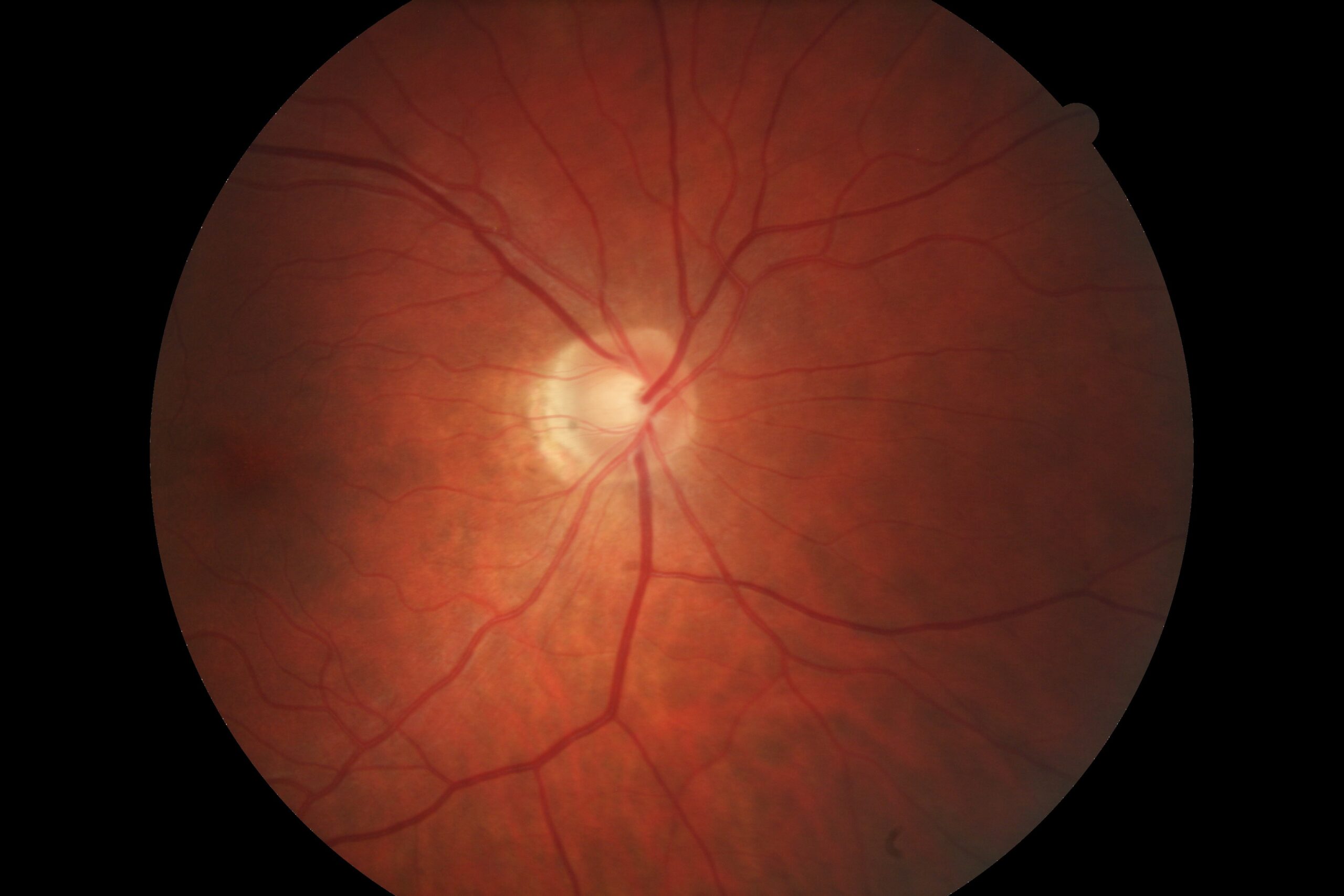 Inside of a Retina with Eye Issue