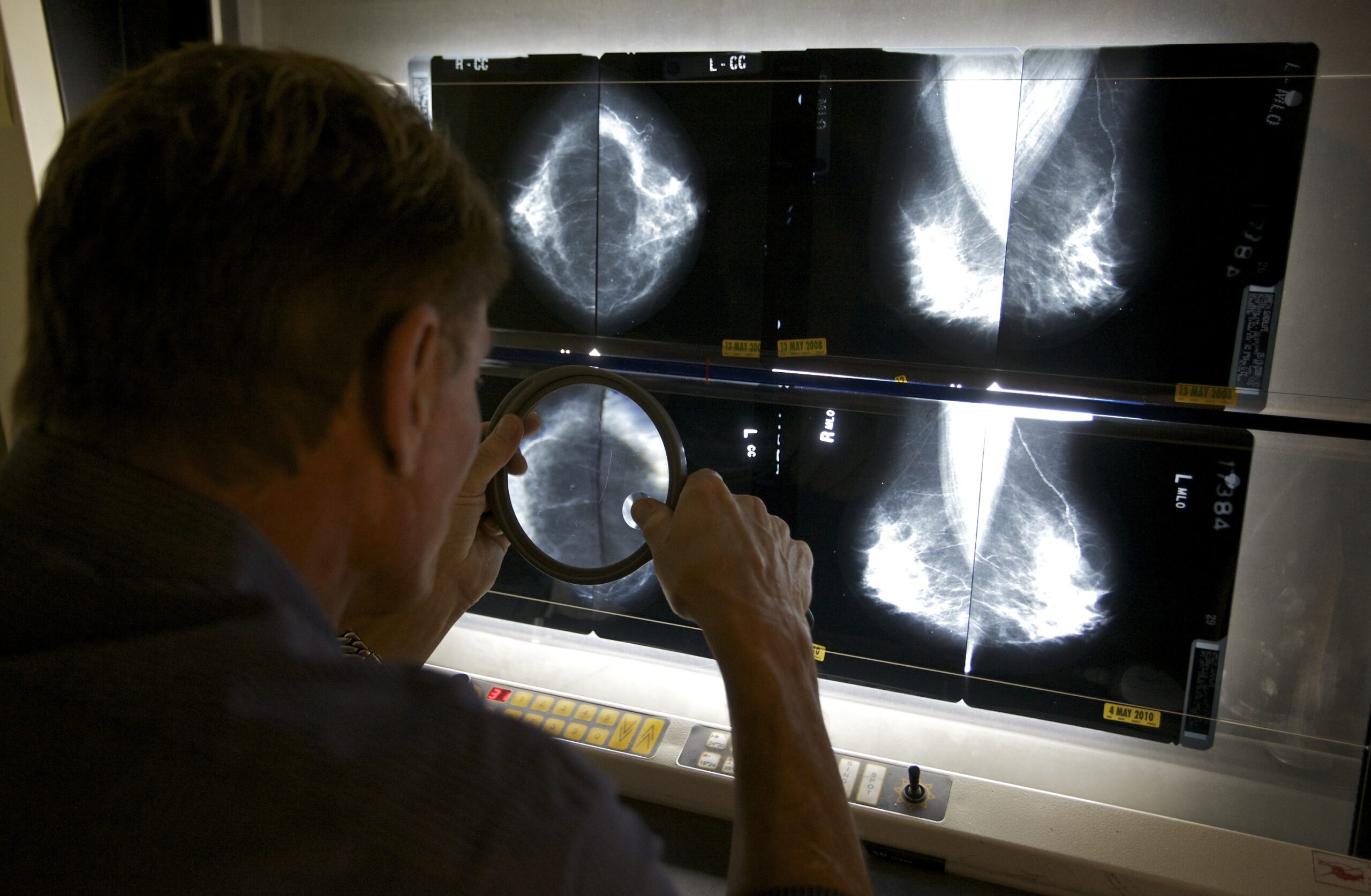 Study: 1 In 3 Women Overdiagnosed With Breast Cancer