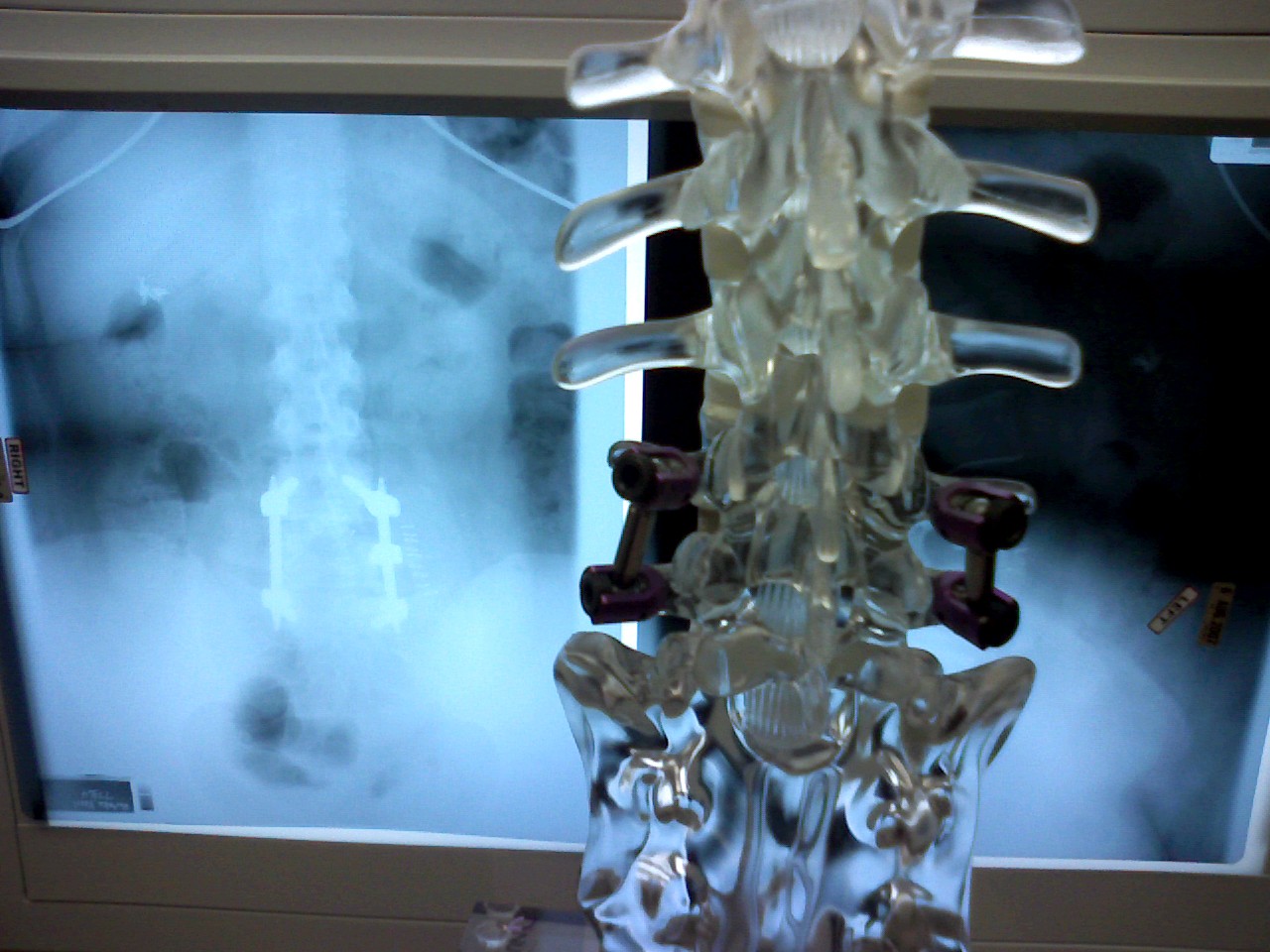 Spinal fusion x-ray and model