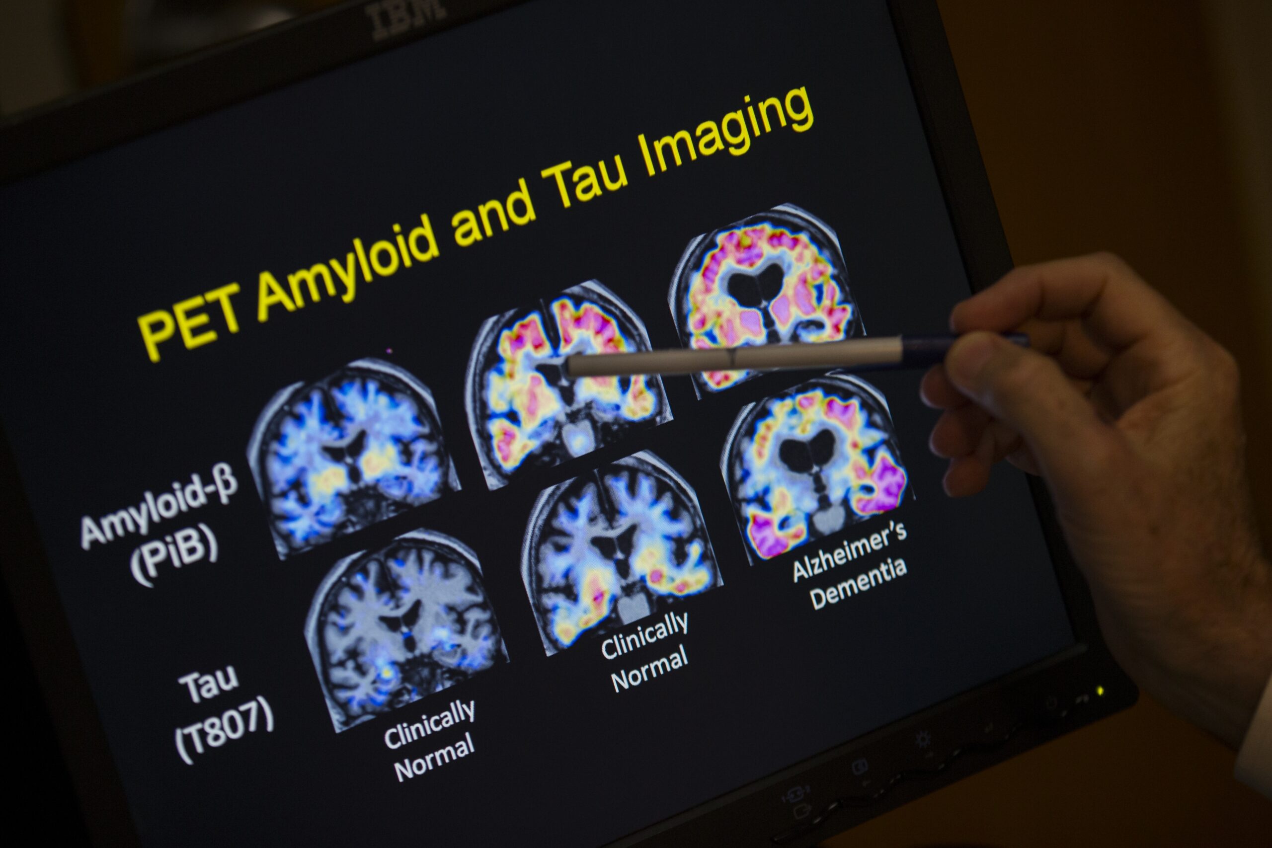 PET scan of Alzheimer's disease