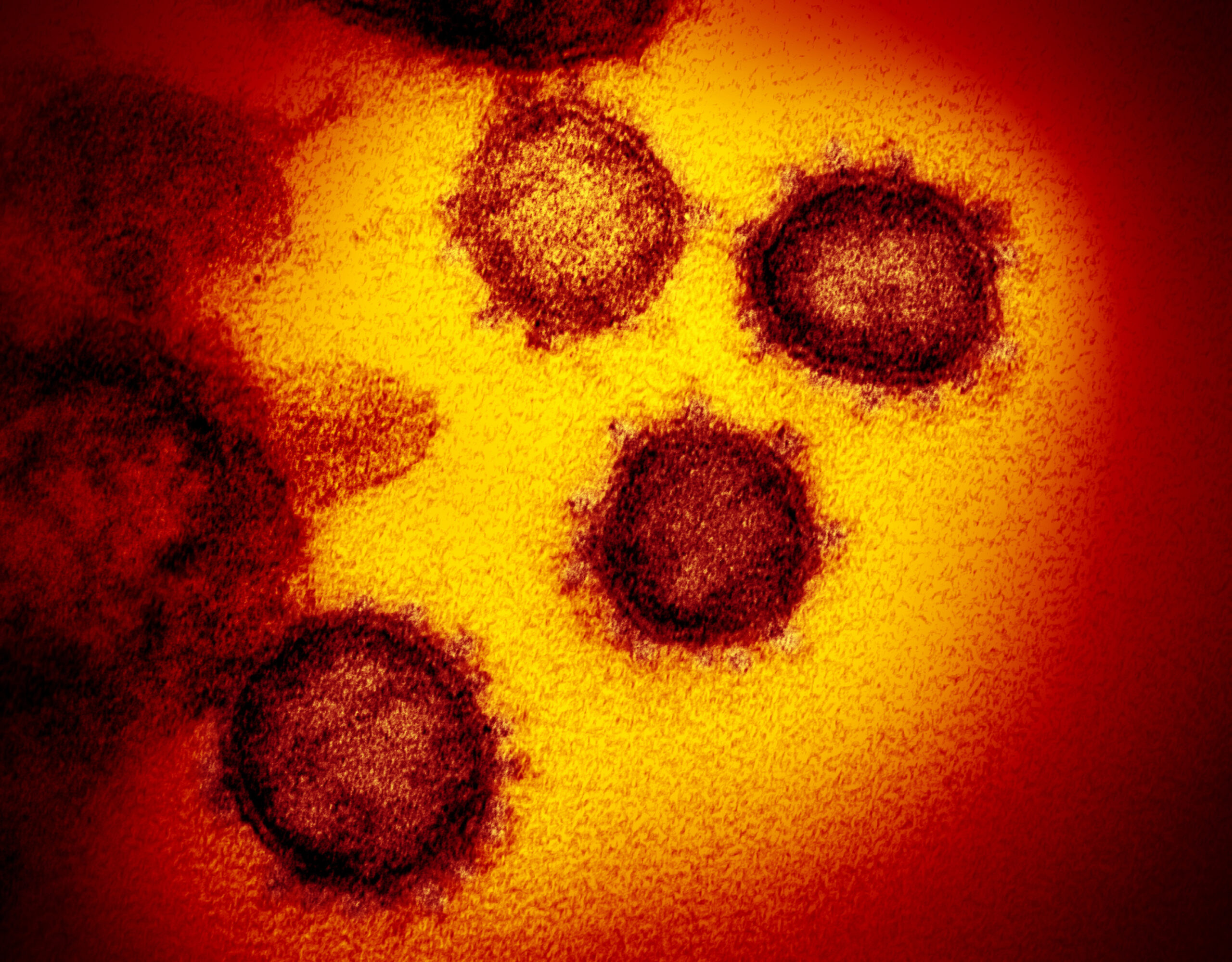 Novel Coronavirus SARS-CoV-2 under an electron microscope