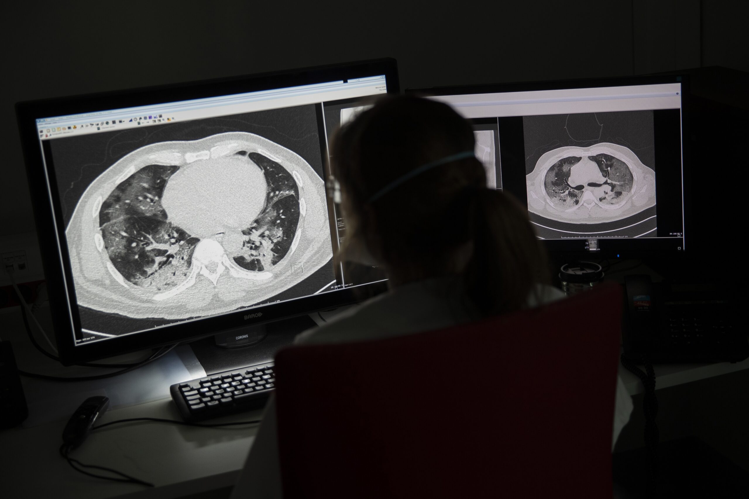 The lungs of COVID-19 patient on a computer screen
