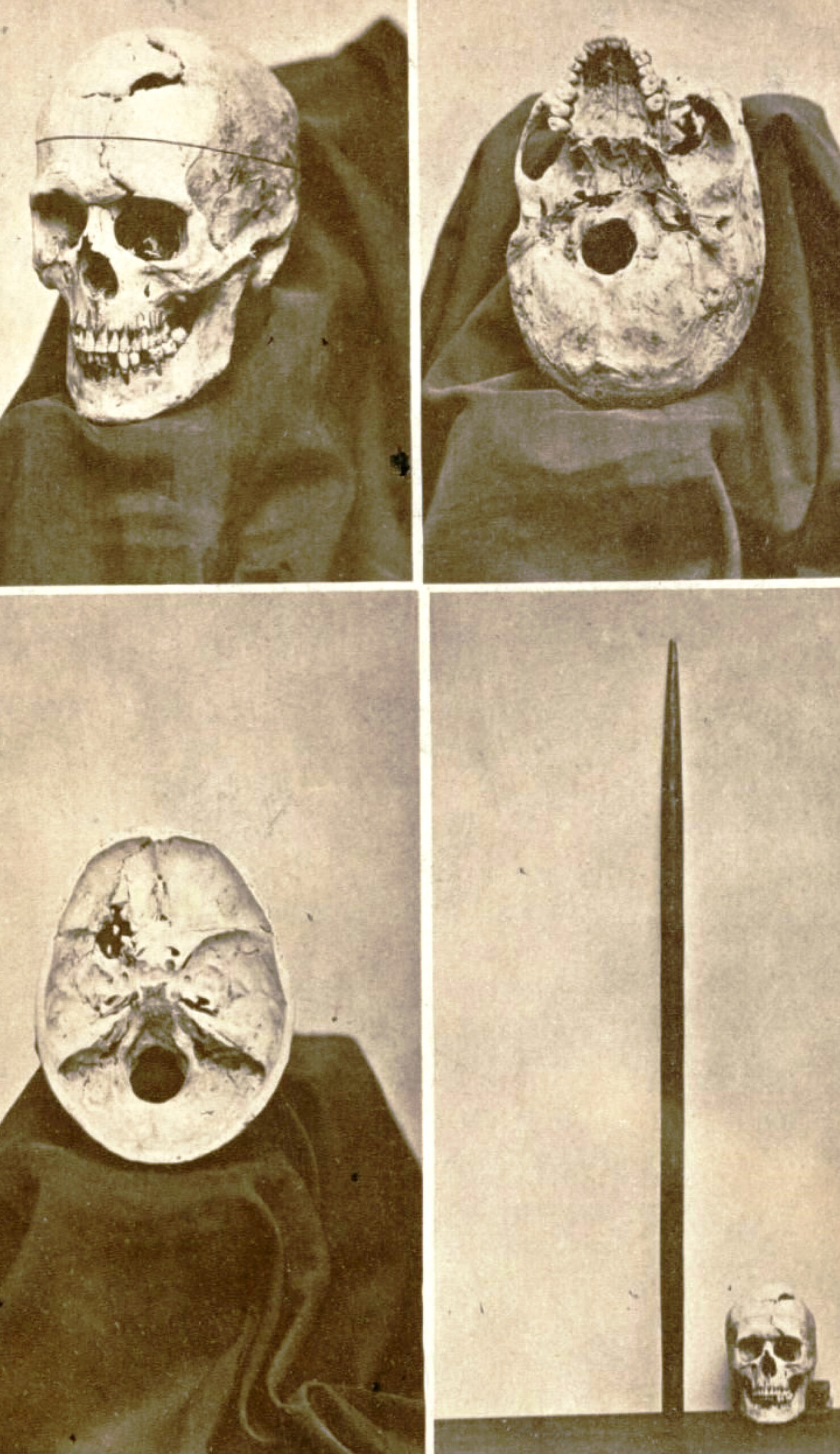 Phineas Gage's skull
