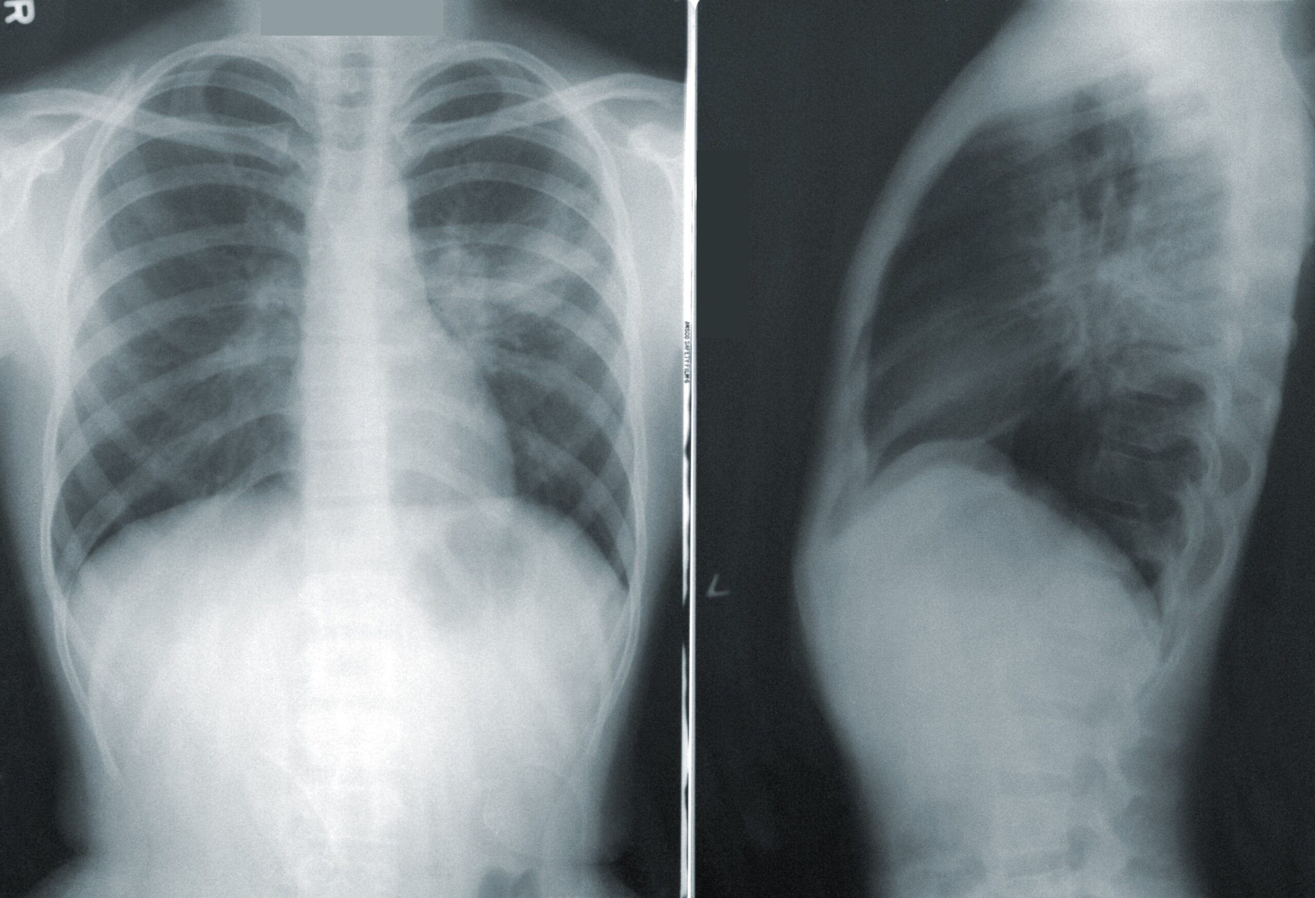 An X-Ray showing pneumonia in the lungs of a COVID-19 patient.