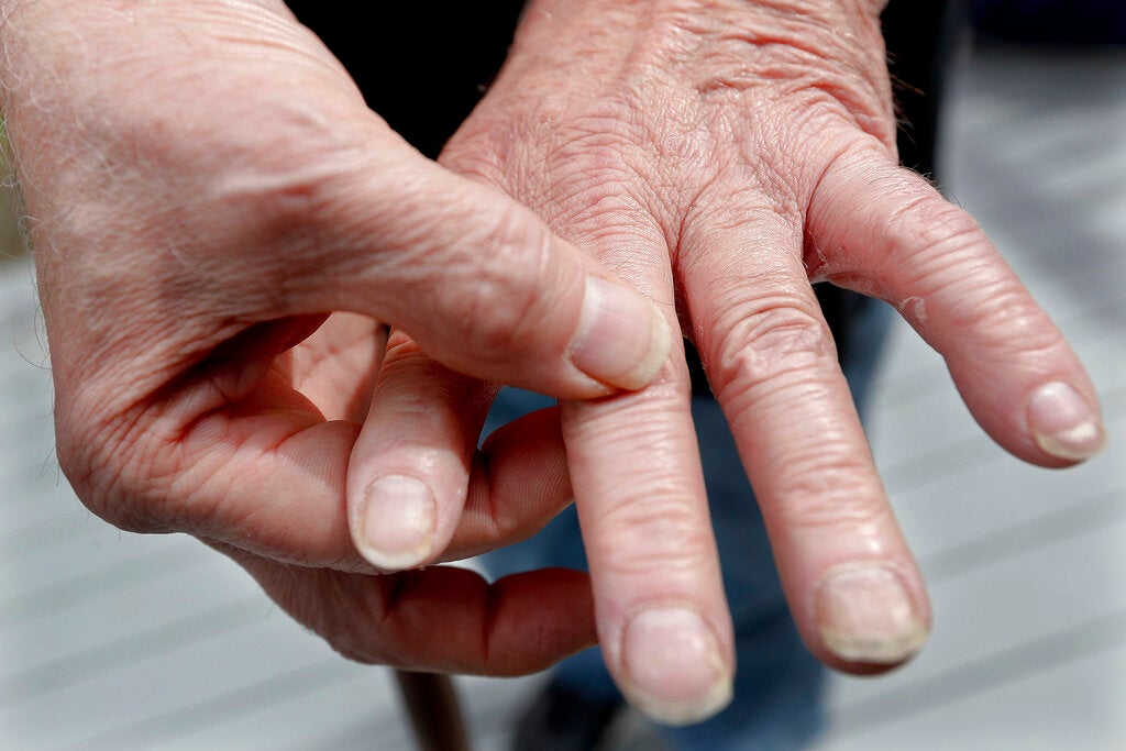 A person with rheumatoid arthritis shows the condition of their hands.