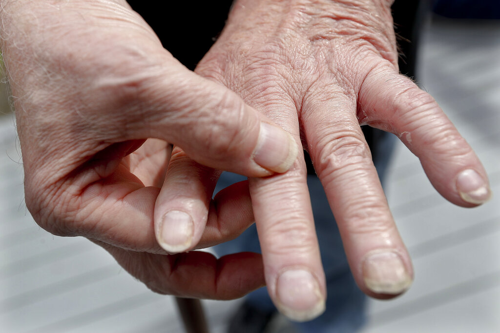A person with rheumatoid arthritis shows the condition of their hands.