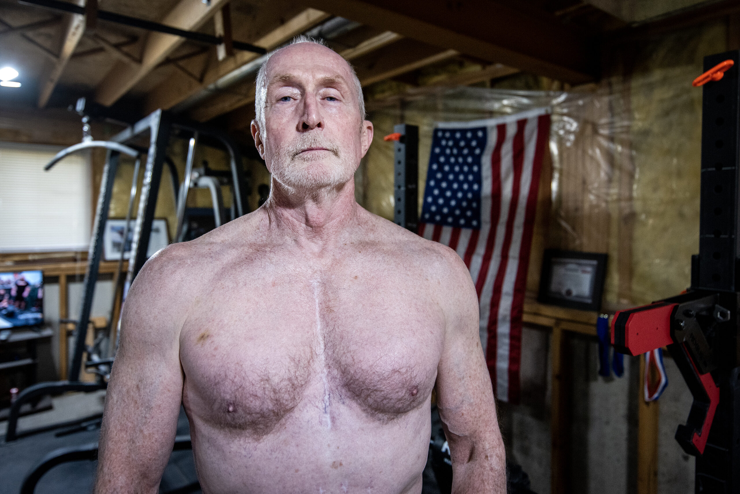 A vertical scar is seen on Michael Love's chest.