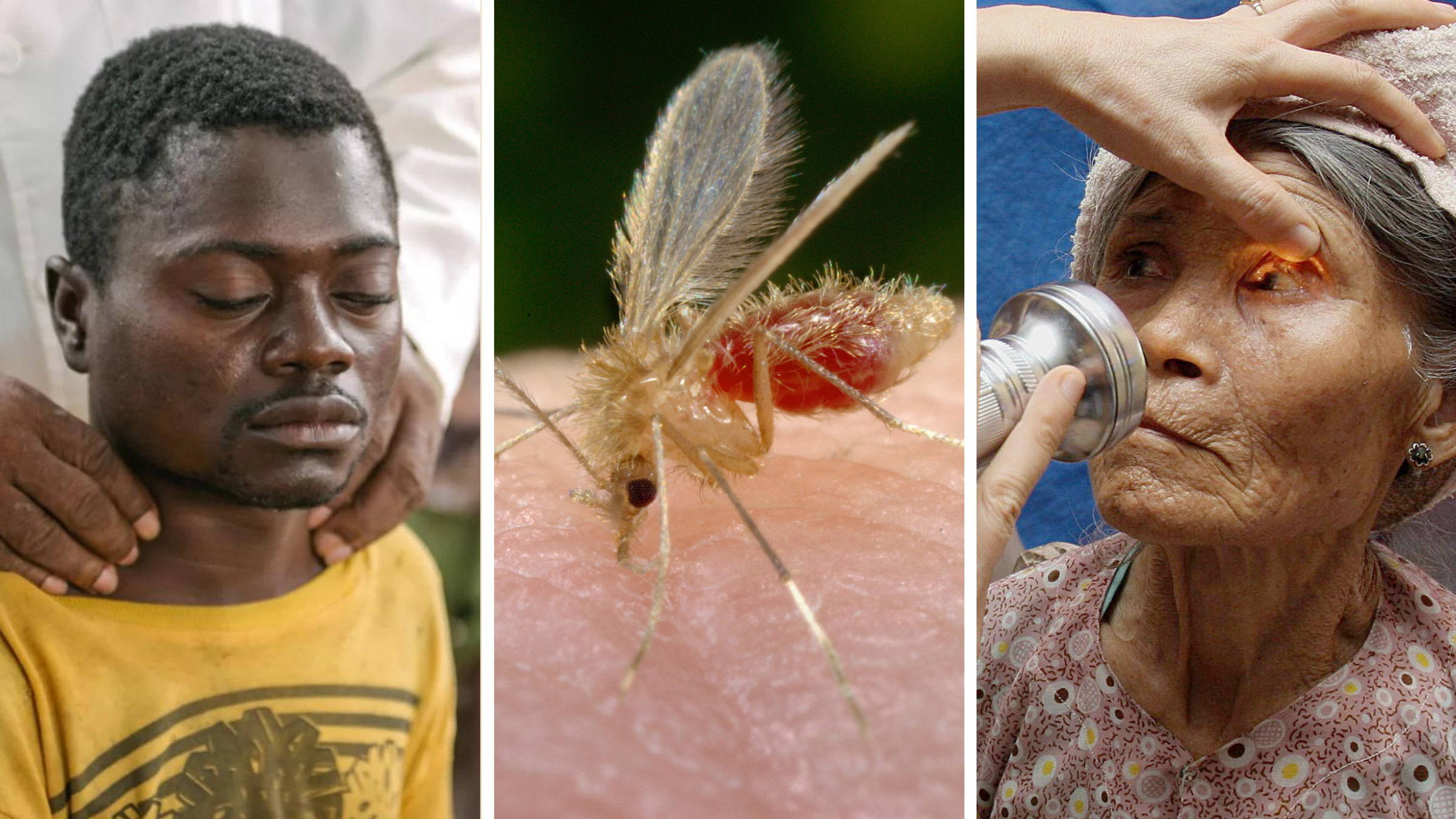 Left to right: Alexis Mukwedi tested positive for sleeping sickness in the Democratic Republic of the Congo. A sandfly,