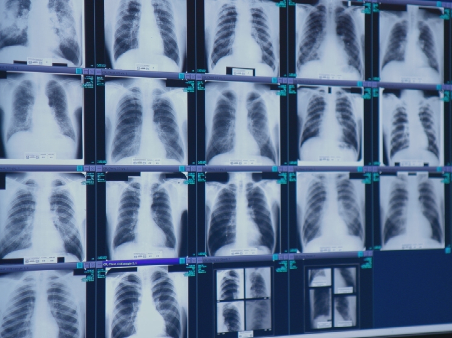The safety rules being announced and finalized today are projected to save about 10 times more miners from catastrophic lung disease than the rules that were first proposed. These x-rays show black lung disease.