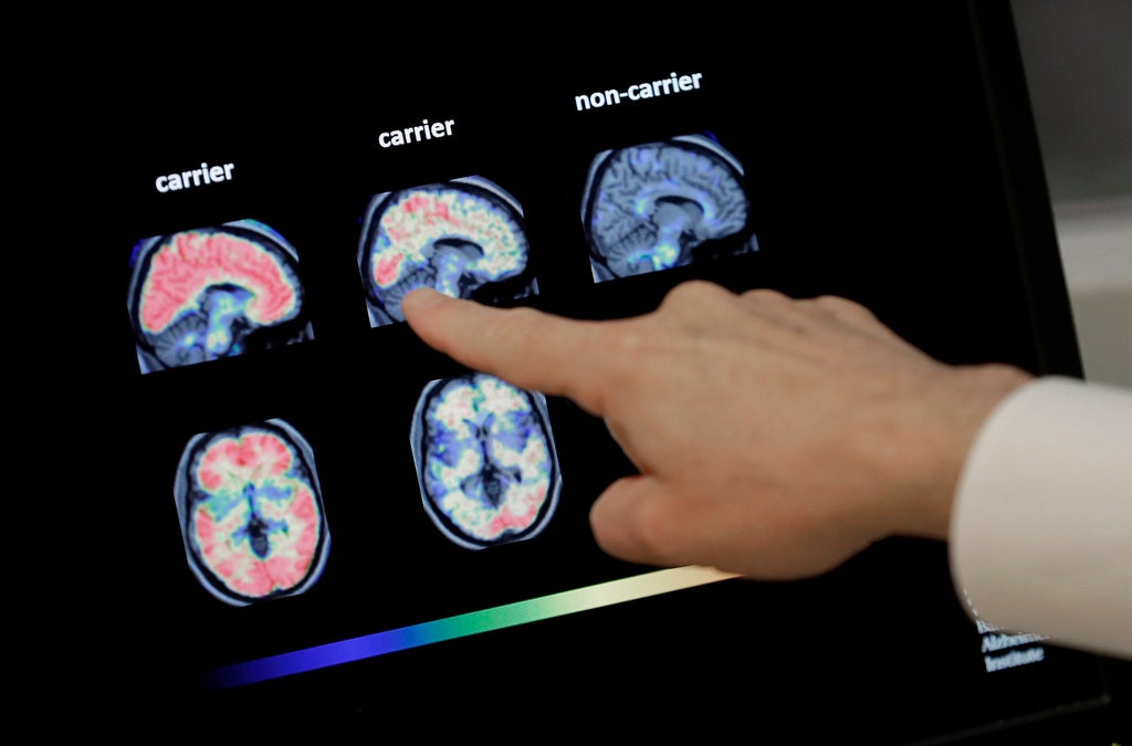 A hand points to brain scan images on a screen, comparing labeled sections carrier and non-carrier, each showing colorful patterns.
